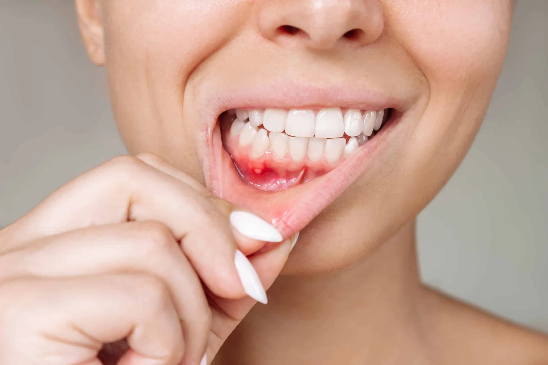 Gingivitis vs Periodontitis