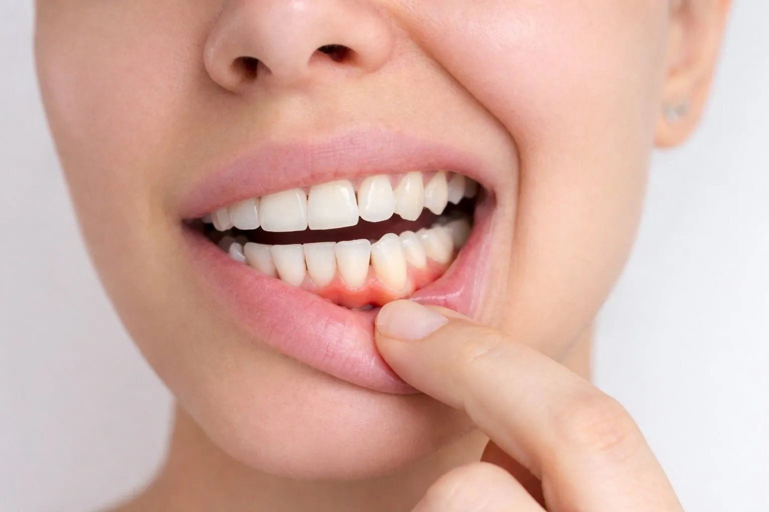 Receding Gums