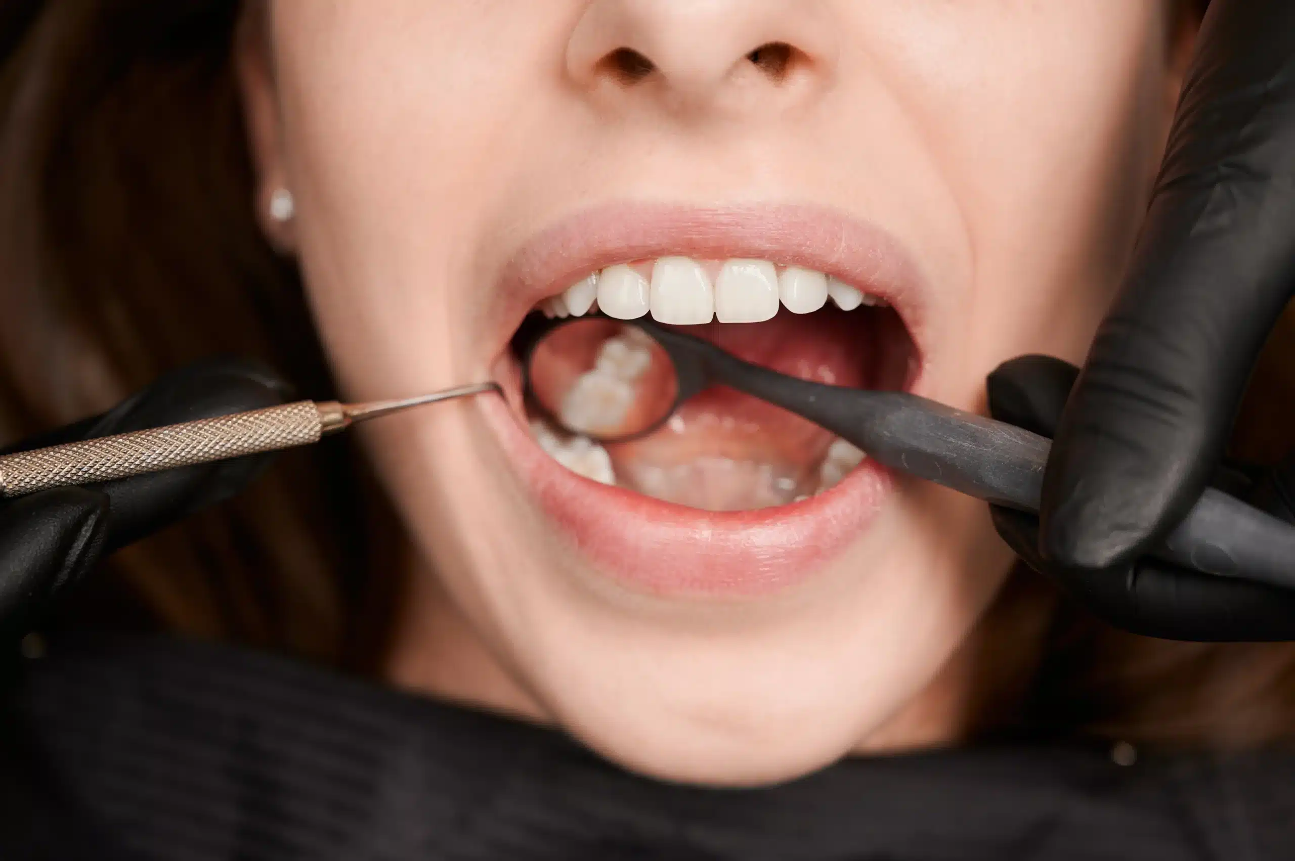 wisdom tooth removal