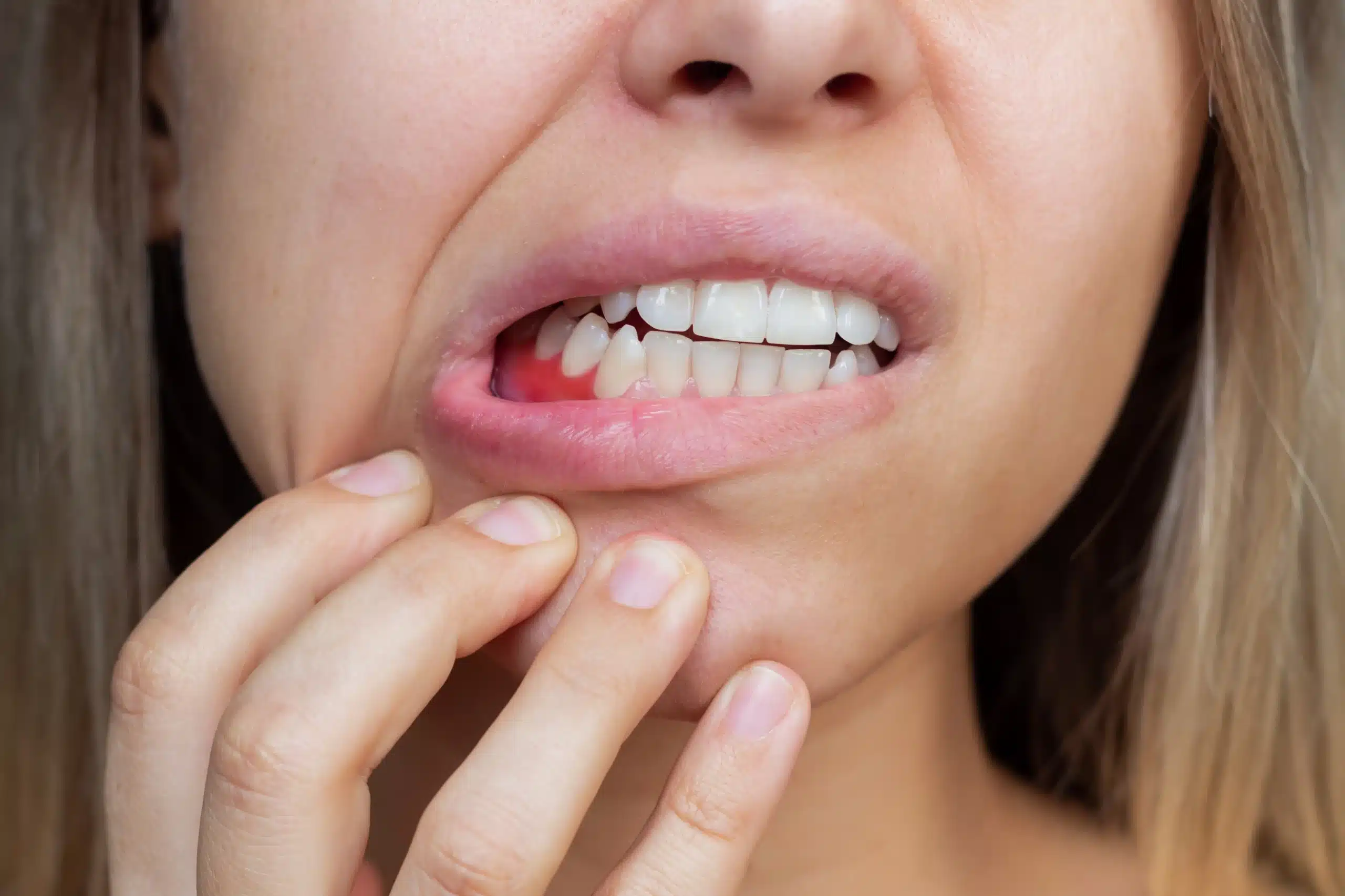 Bleeding Gums