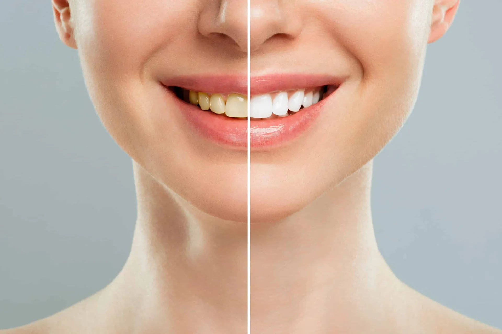 Why Your Teeth Look Yellow After Brushing and What Your Dentist Can Actually Do