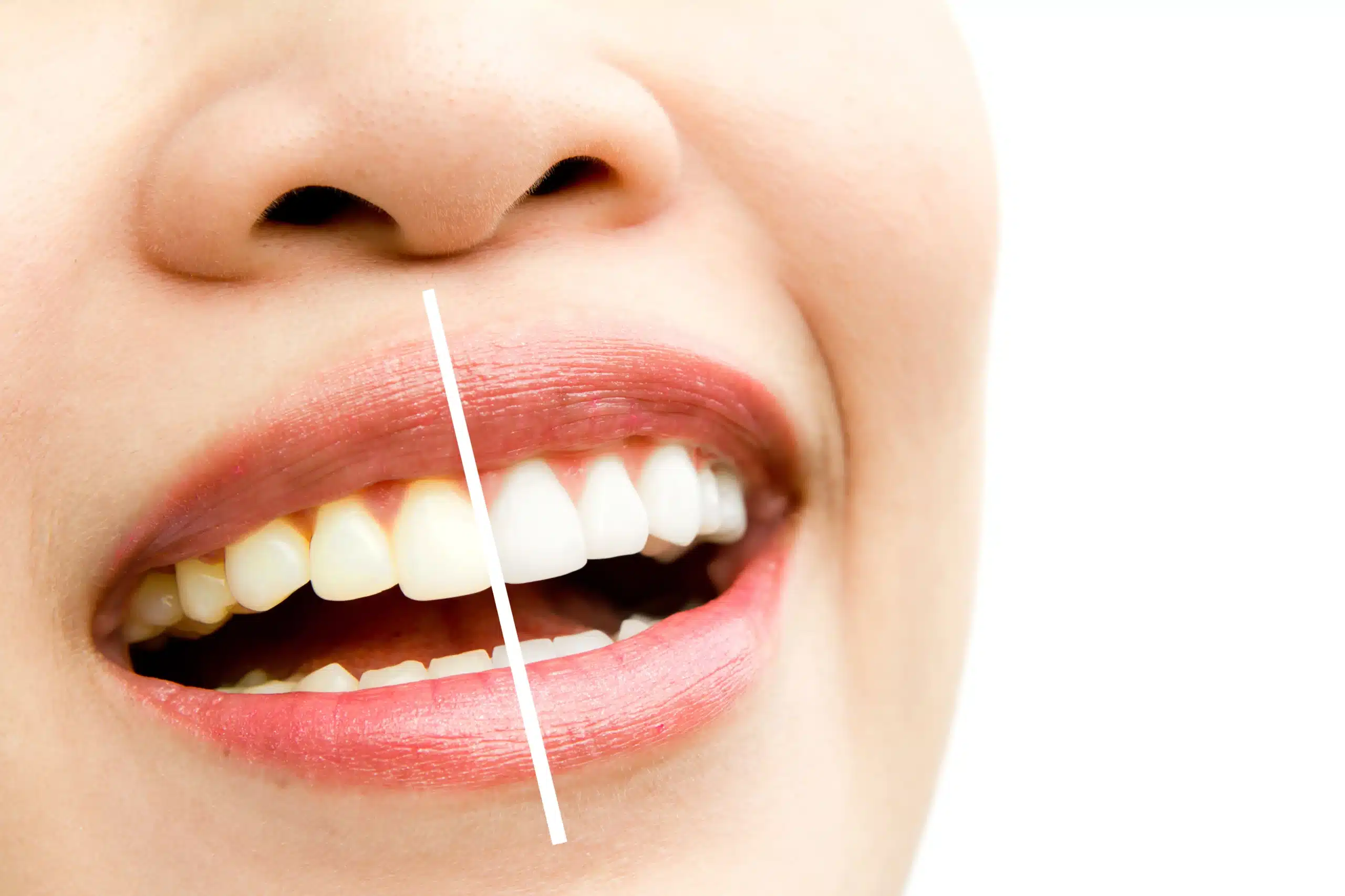 teeth whitening cost