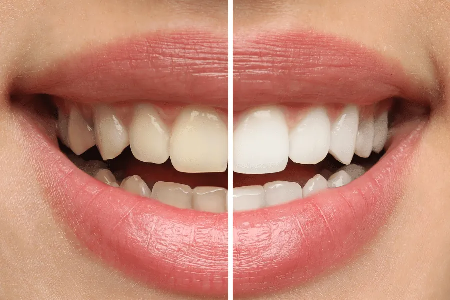 veneer vs whitening