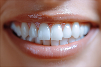 Teeth Whitening for Sensitive Teeth: Is It Safe?