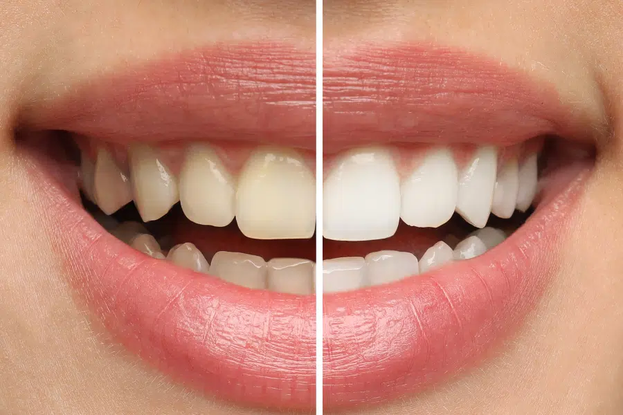 Whitening and veneers