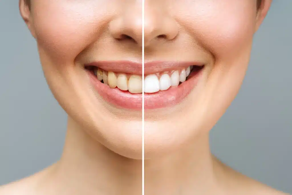 teeth-whitening