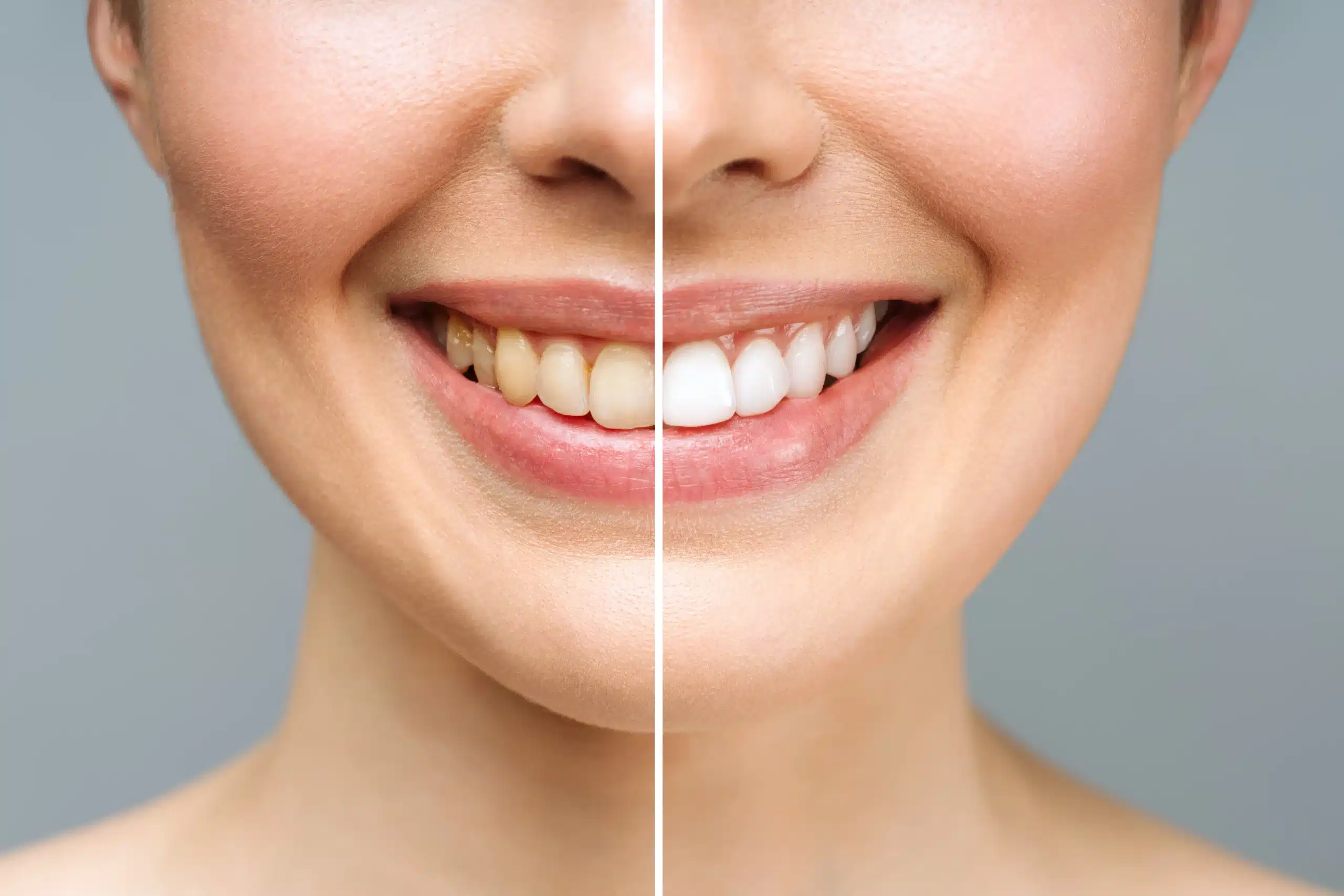 teeth-whitening