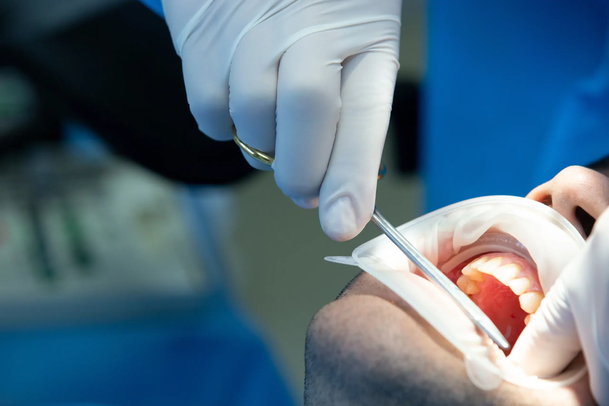 Root Canal Treatments