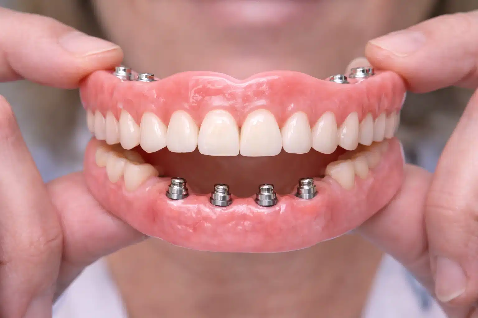 Implant-Supported Dentures