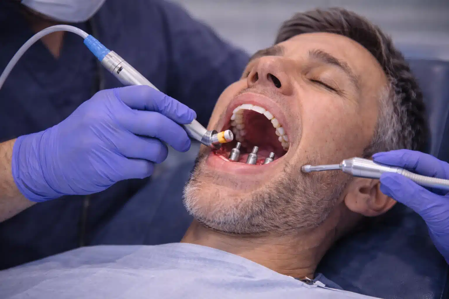 Single Arch Dental Implants