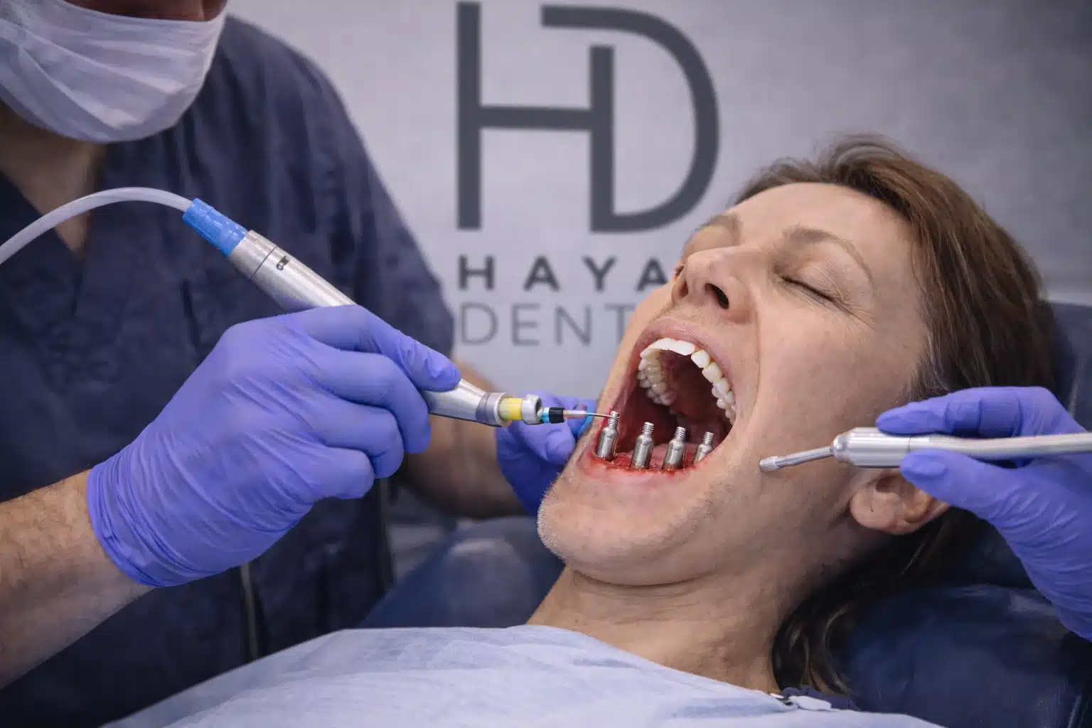 Same Day Dental Implants