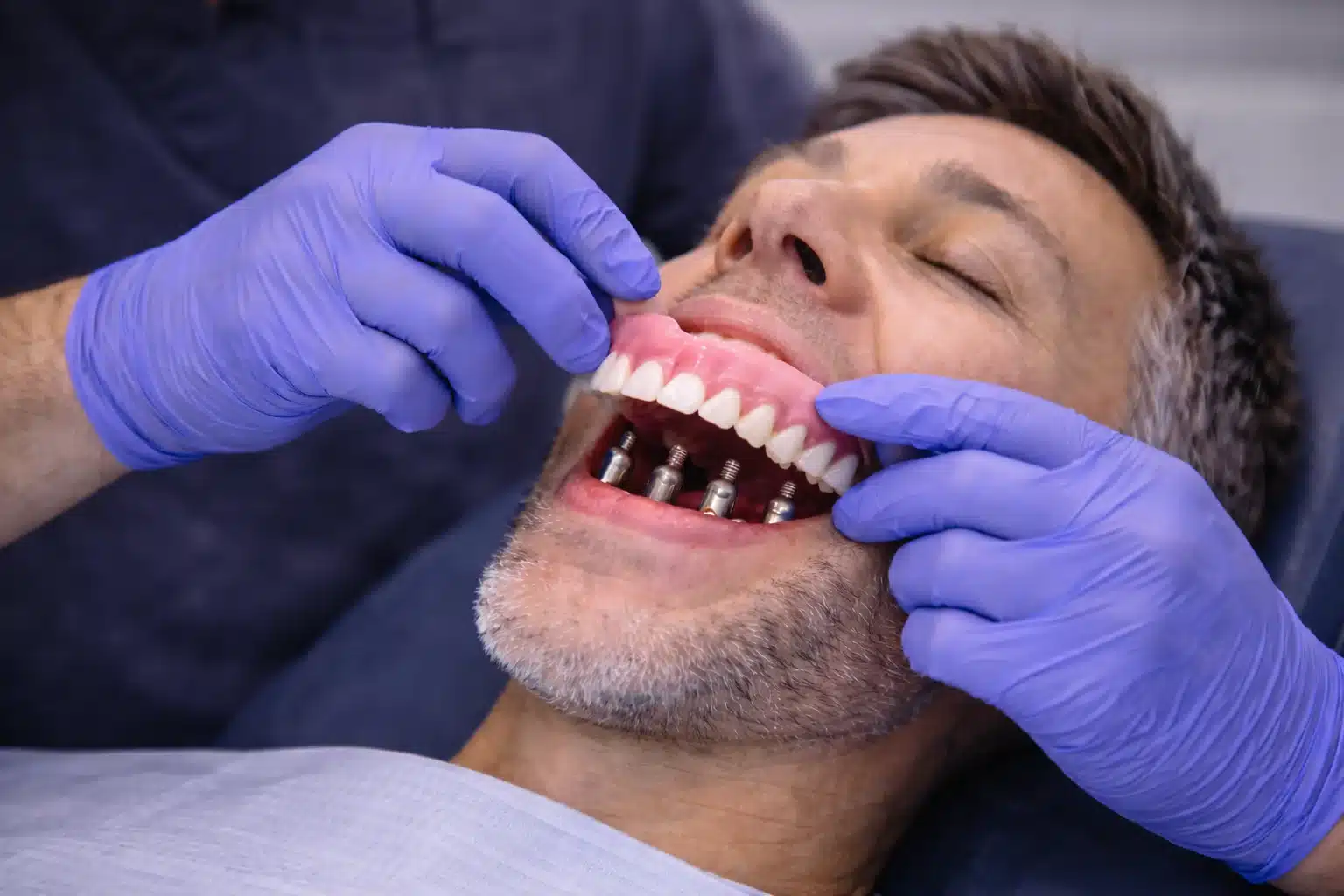 Implant-Supported Dentures