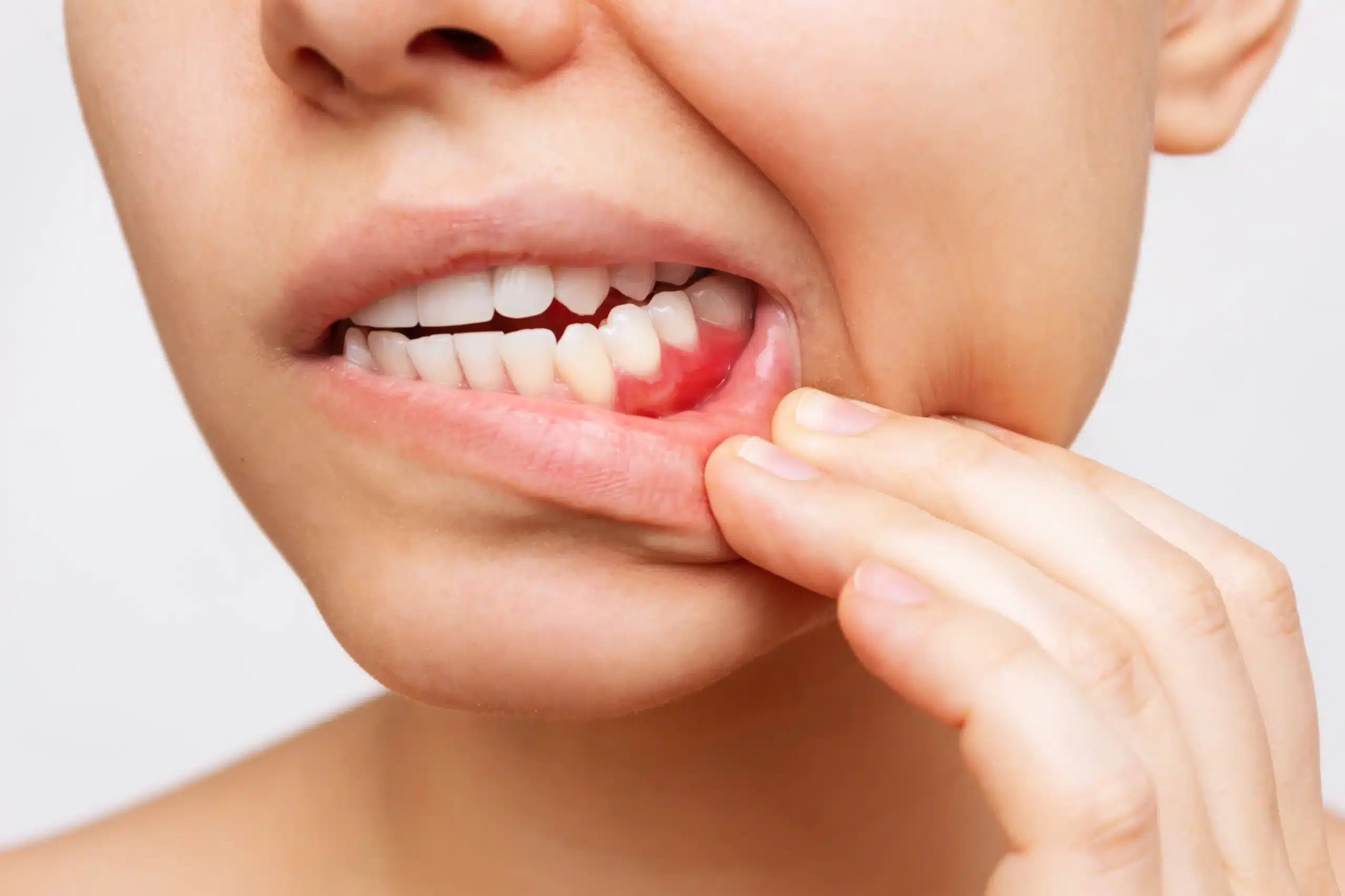 Gum disease