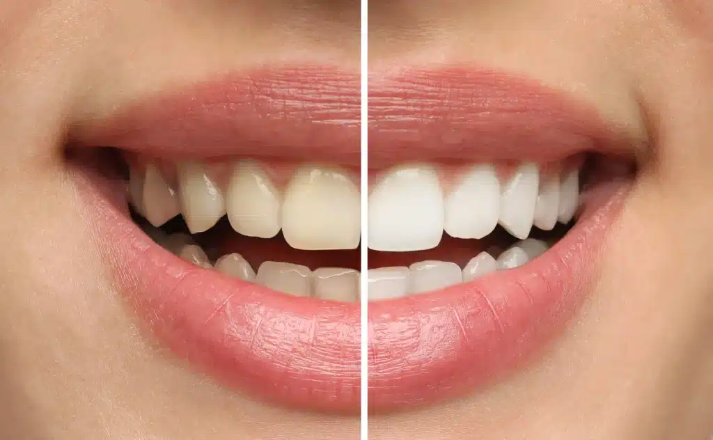 Teeth whitening Sydney