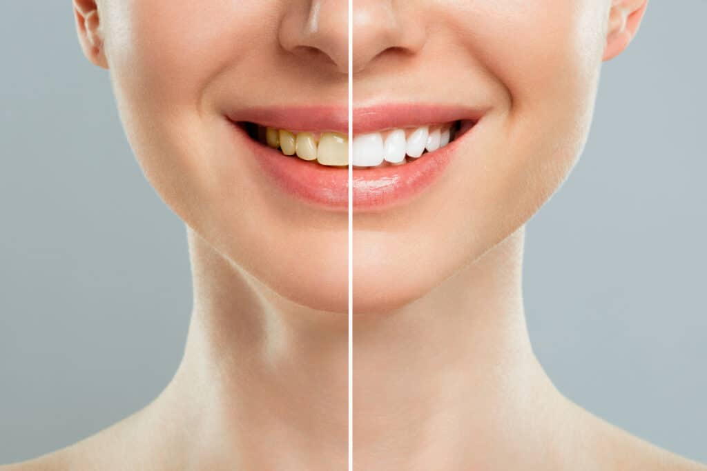 woman teeth before after whitening white background dental clinic patient image symbolizes oral care dentistry stomatology