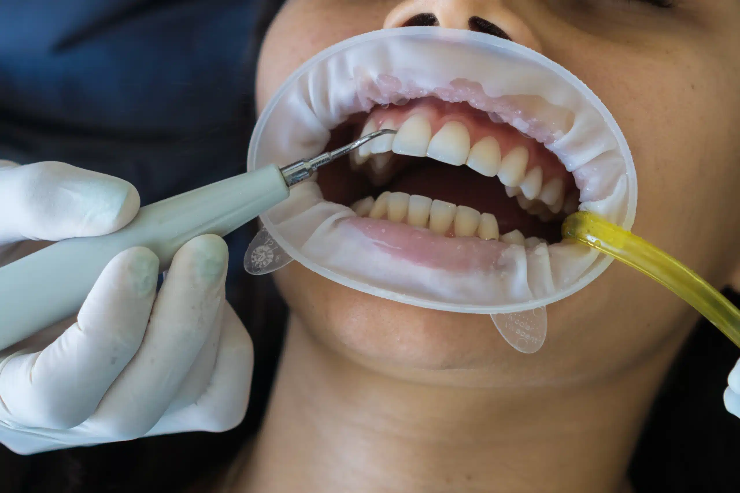 Dentist examining a patient’s front teeth