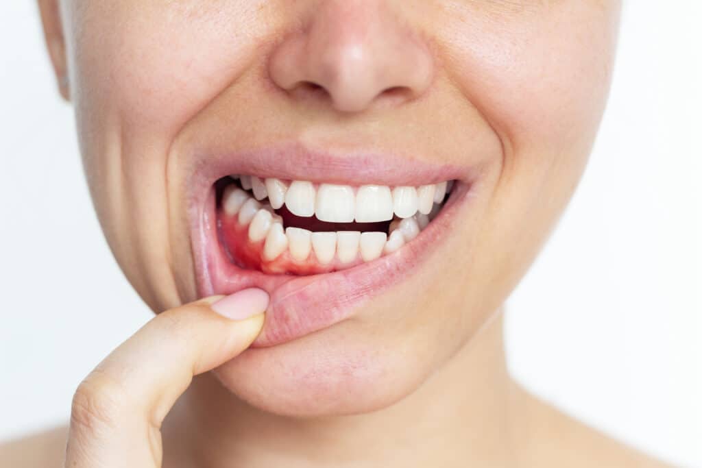 Gum Disease