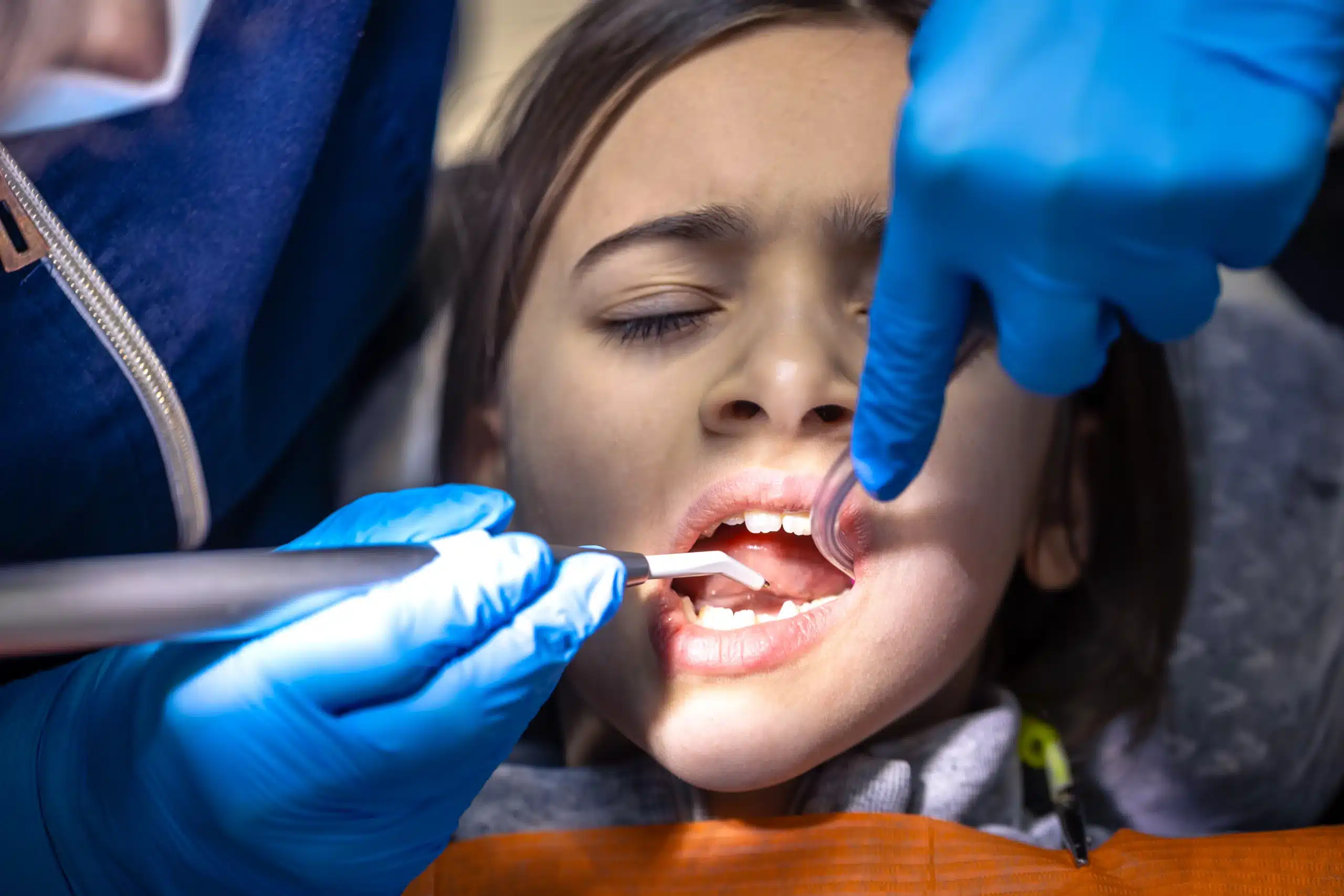 Kids' Fluoride Treatments