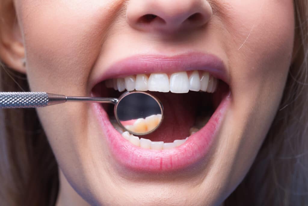 teeth dentist mouth mirror closeup examination teeth with dental mirror ideal teeth dental tools