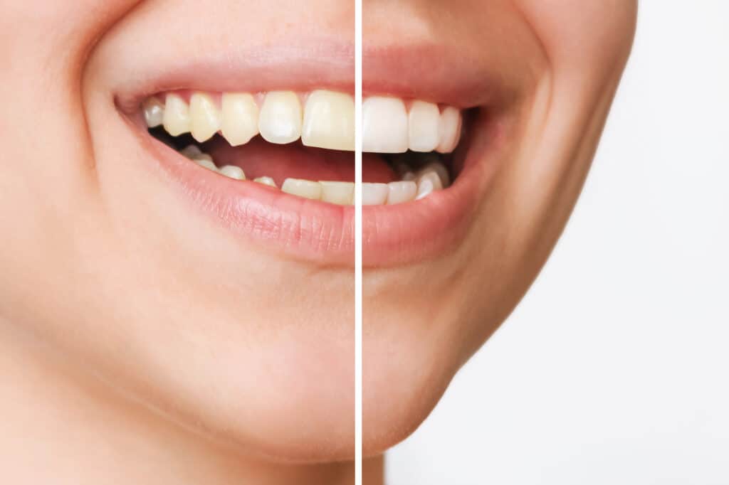 Teeth Whitening