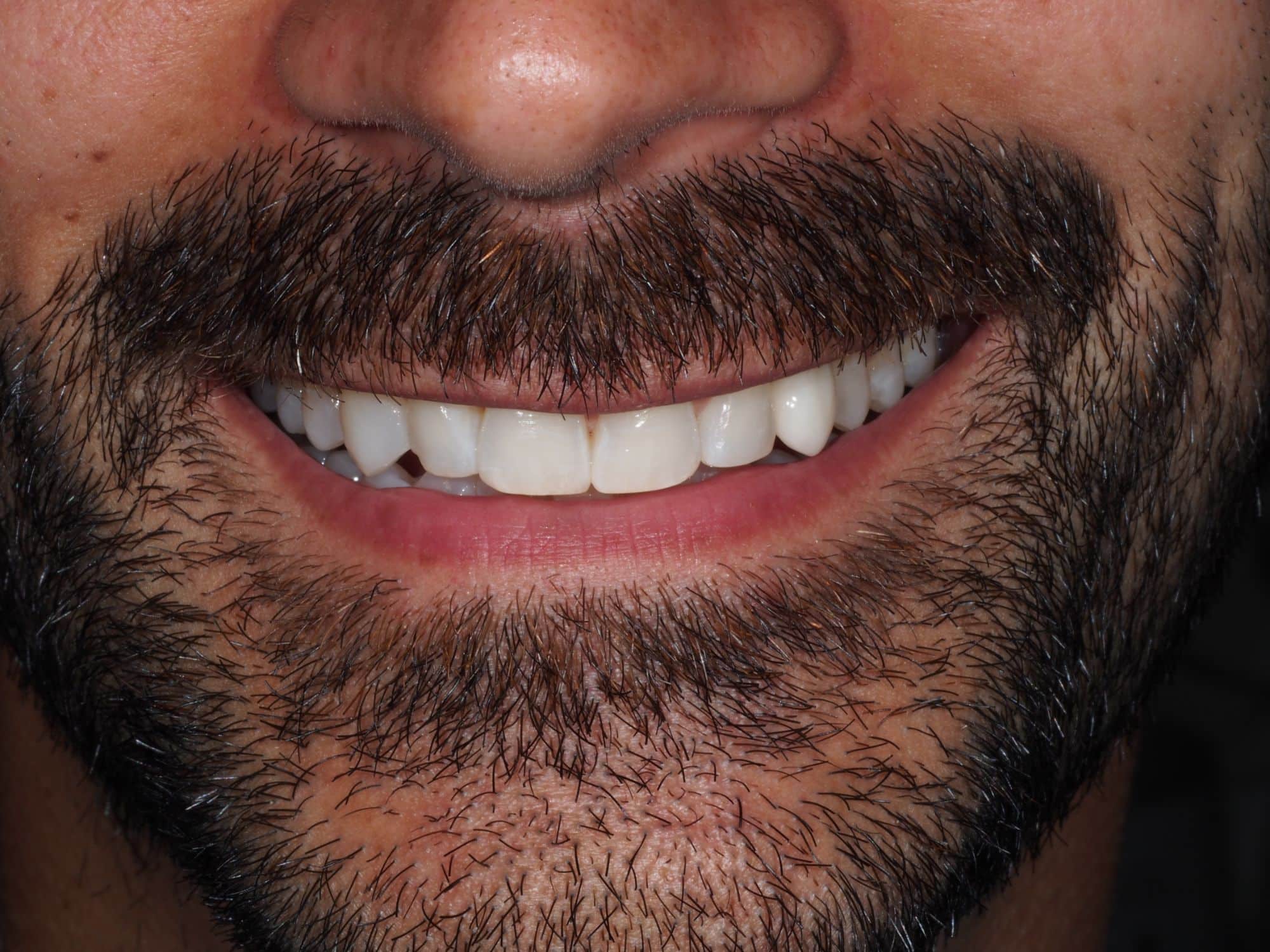 Patient smile at Hayat Dental