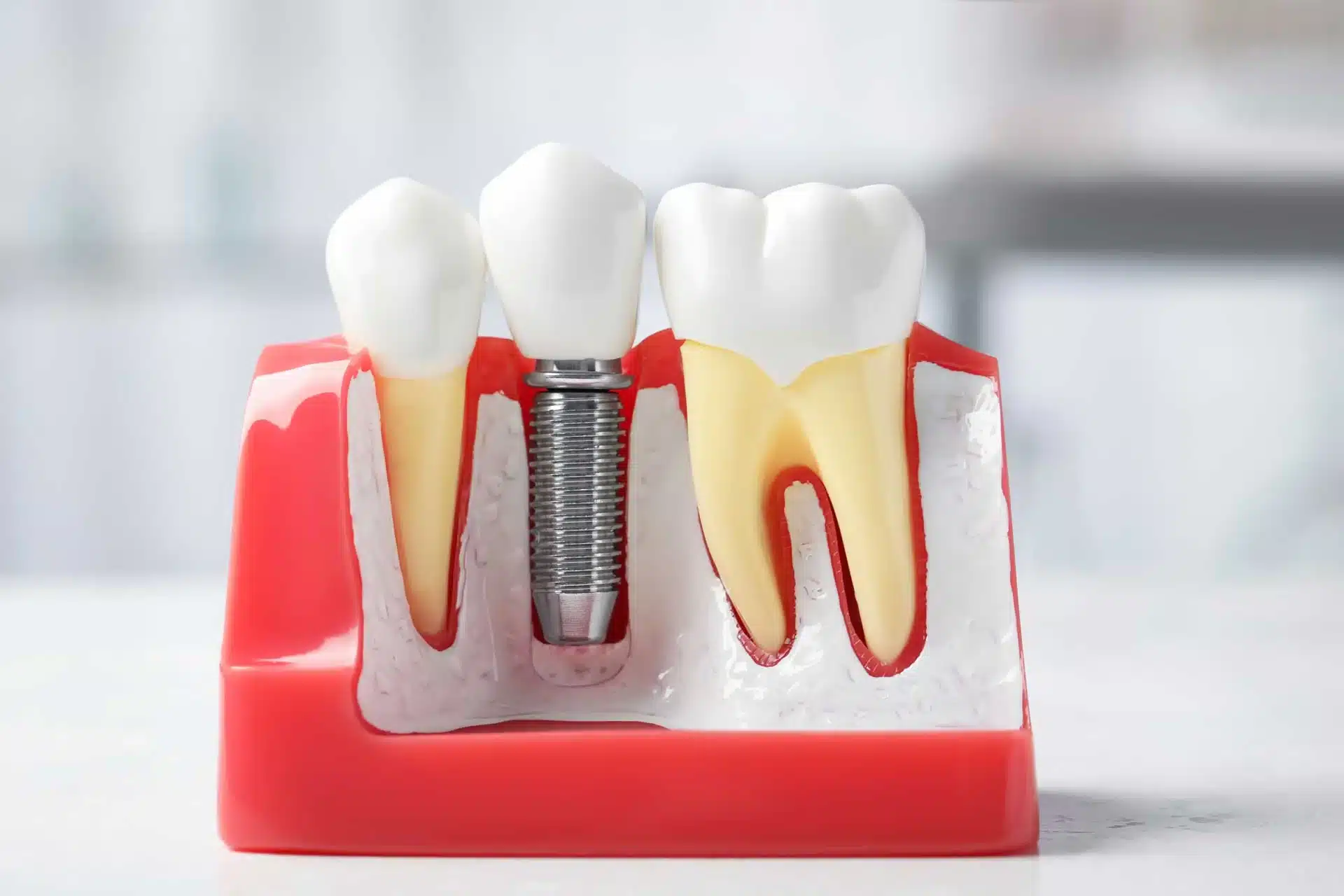 Dental model showing an implant in the gum and bone beside natural teeth