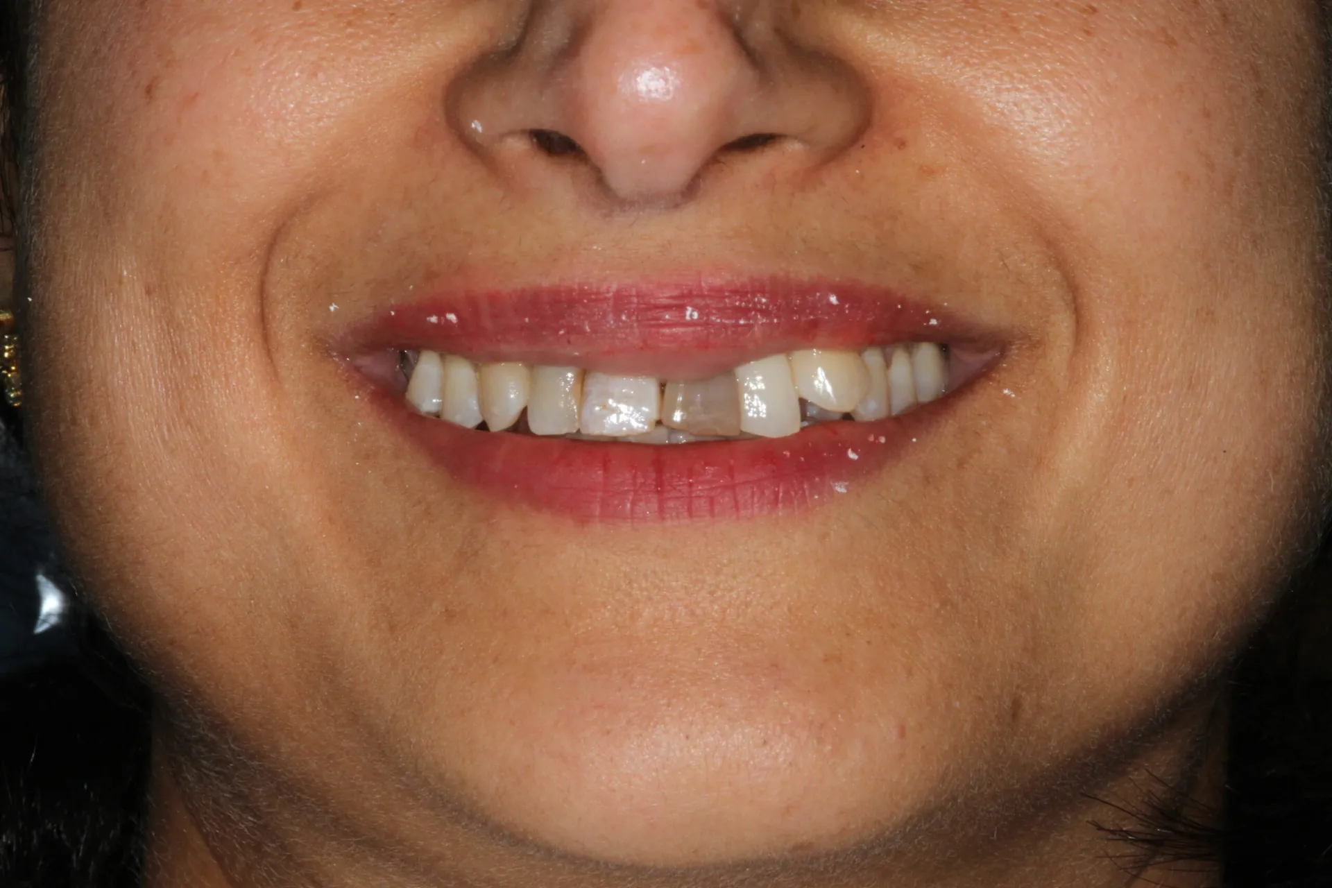 Before: the upper left front tooth had turned grey-brown after root canal treatment