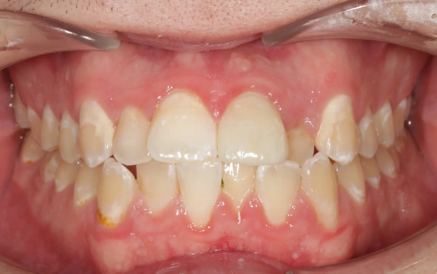 Before treatment