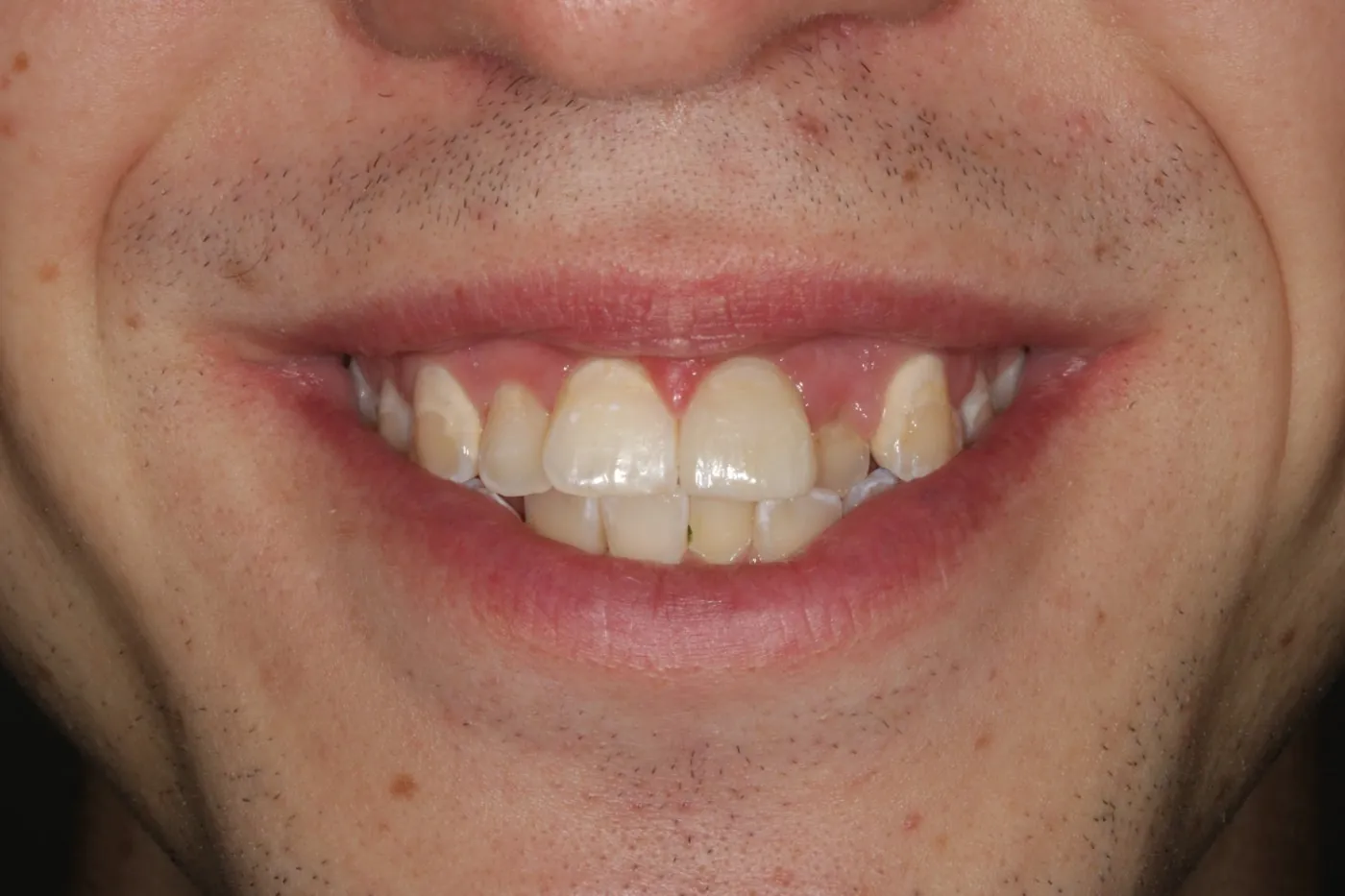 Before treatment