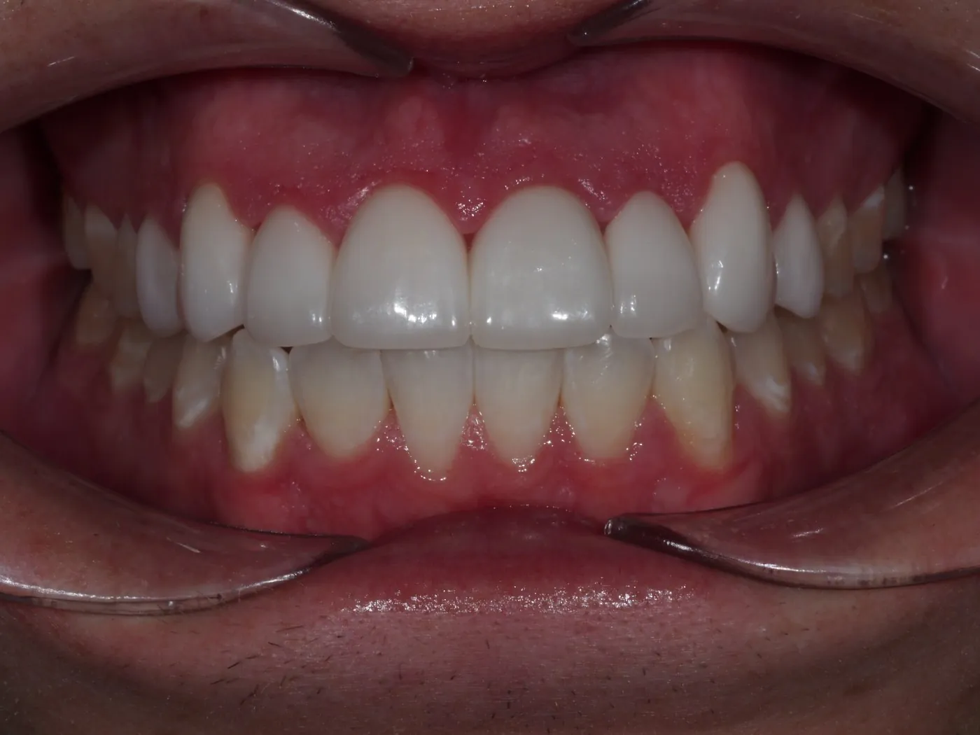 After treatment: close-up of the teeth after treatment