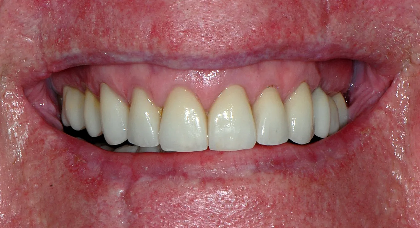 After: Replacing old crowns with dark edges and black triangles