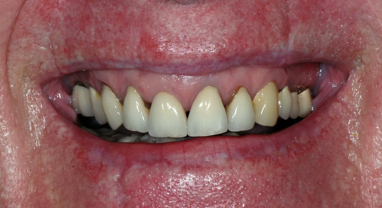 Before: Replacing old crowns with dark edges and black triangles