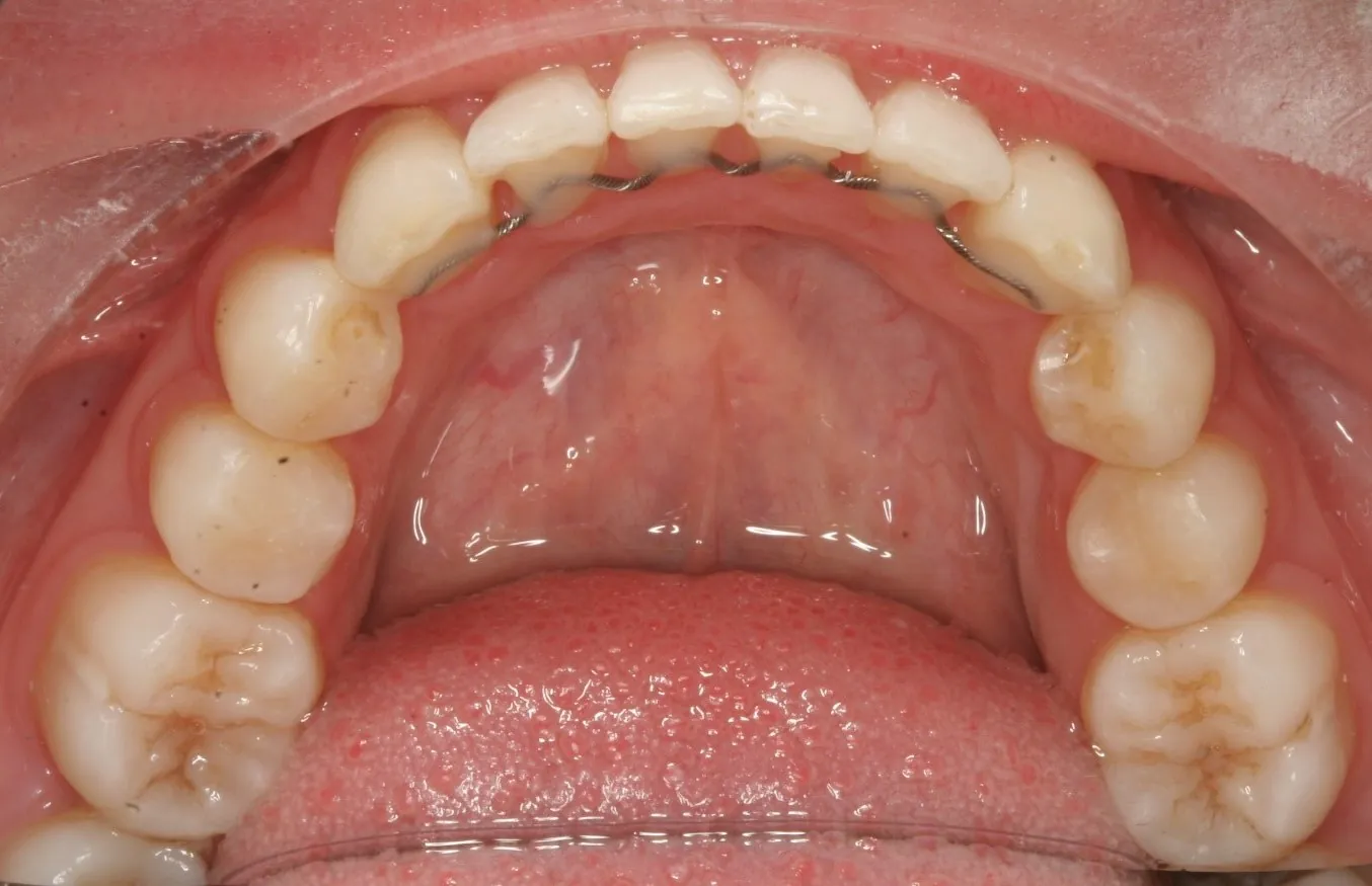 After: Braces to widen a narrow, crowded smile
