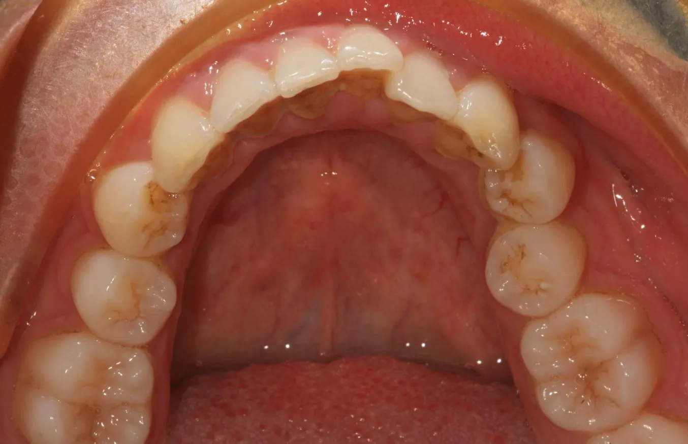 Before: Braces to widen a narrow, crowded smile