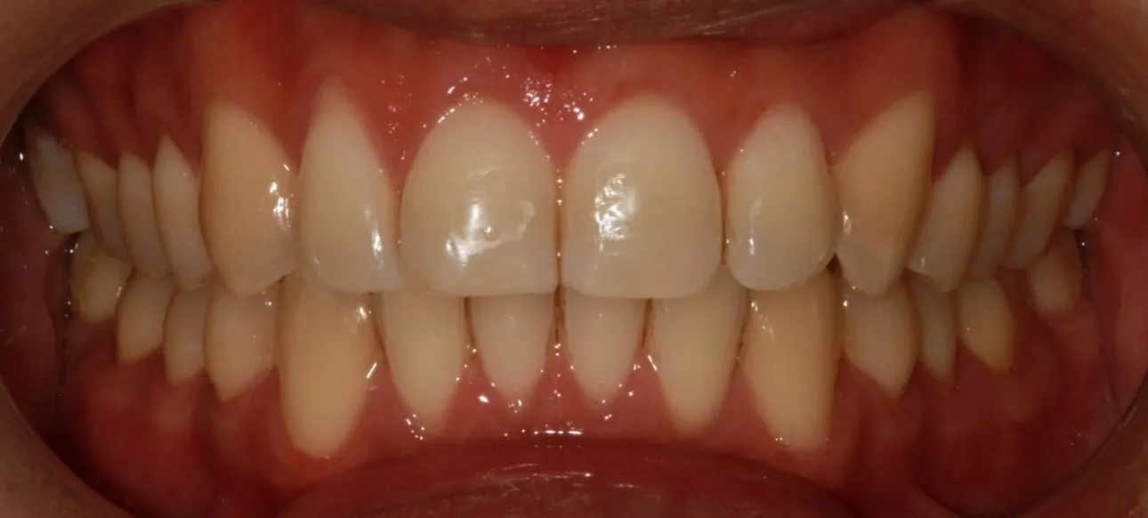 After: Invisalign for very crowded teeth and prominent canines