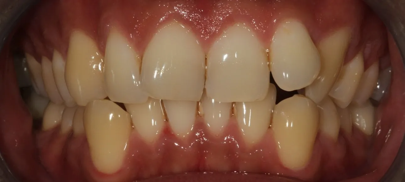 Before: Invisalign for very crowded teeth and prominent canines