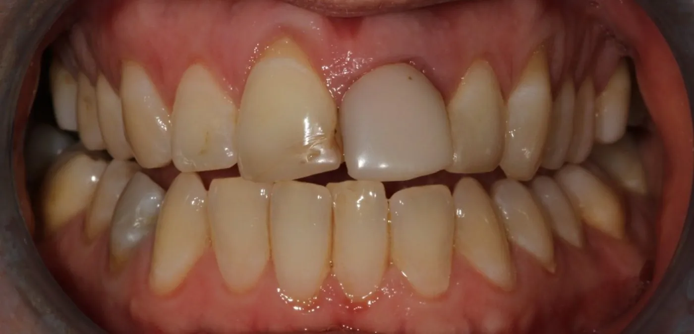 Before treatment