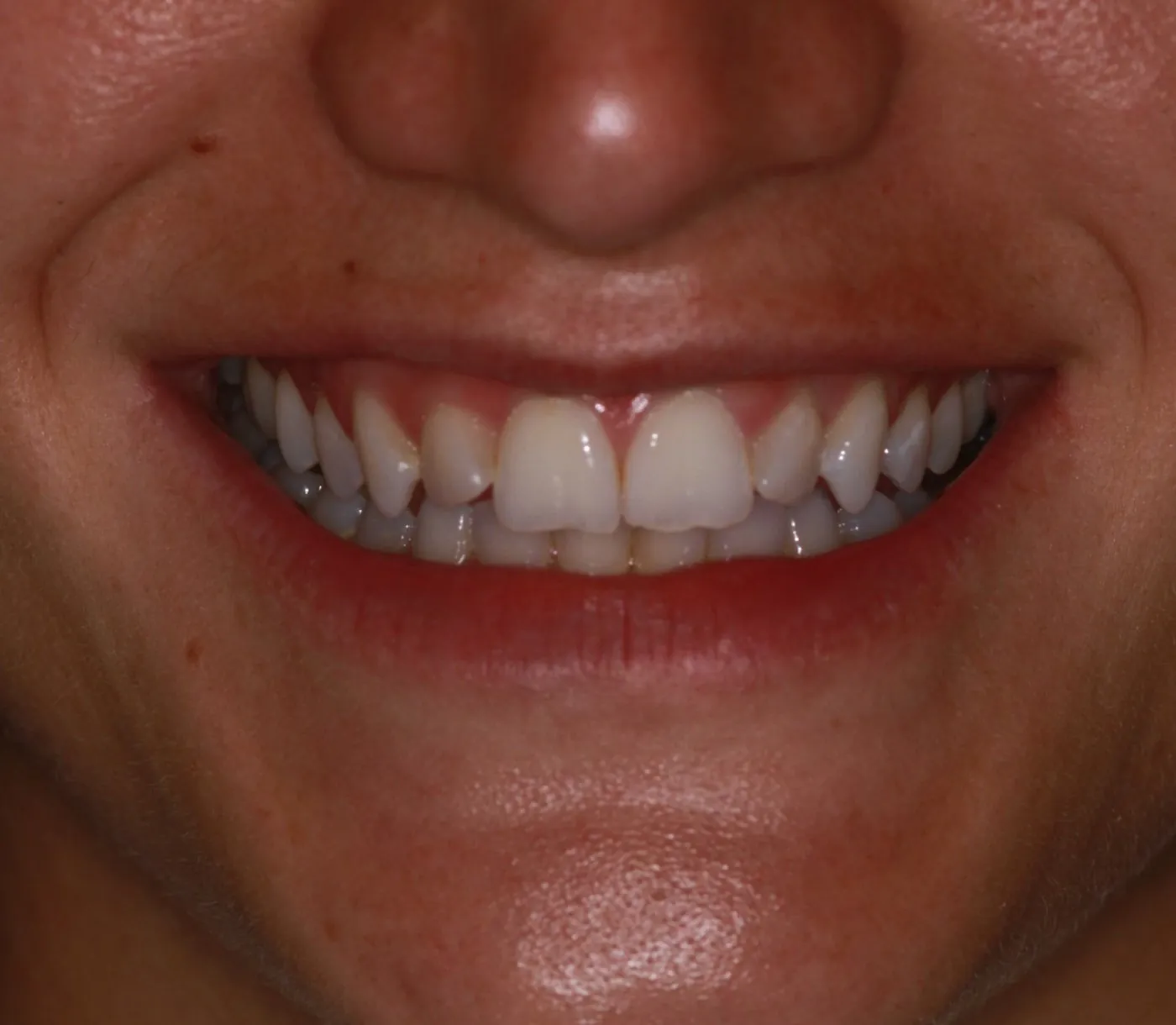 Before treatment