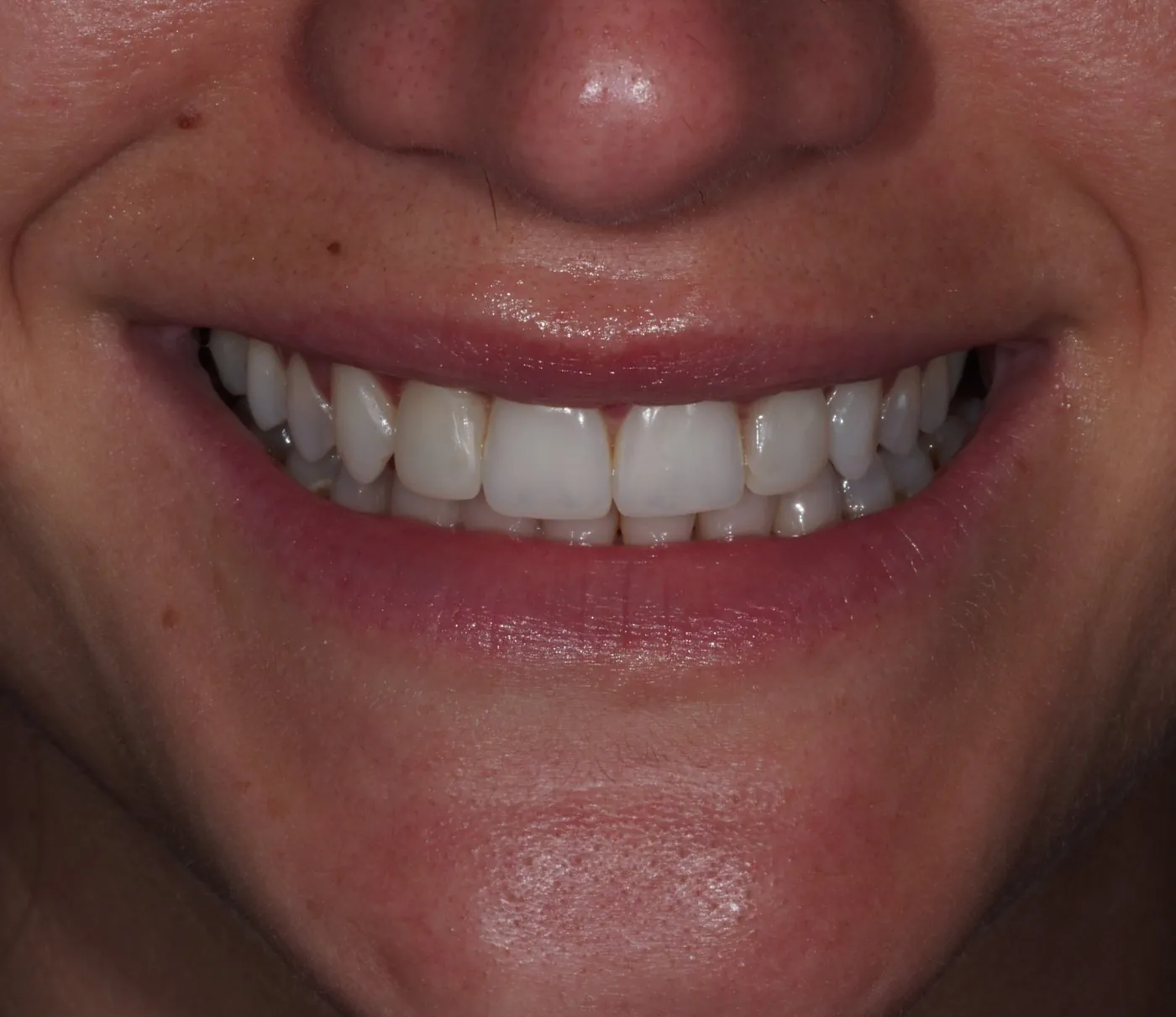 After: Gum reshaping and composite veneers for small side teeth