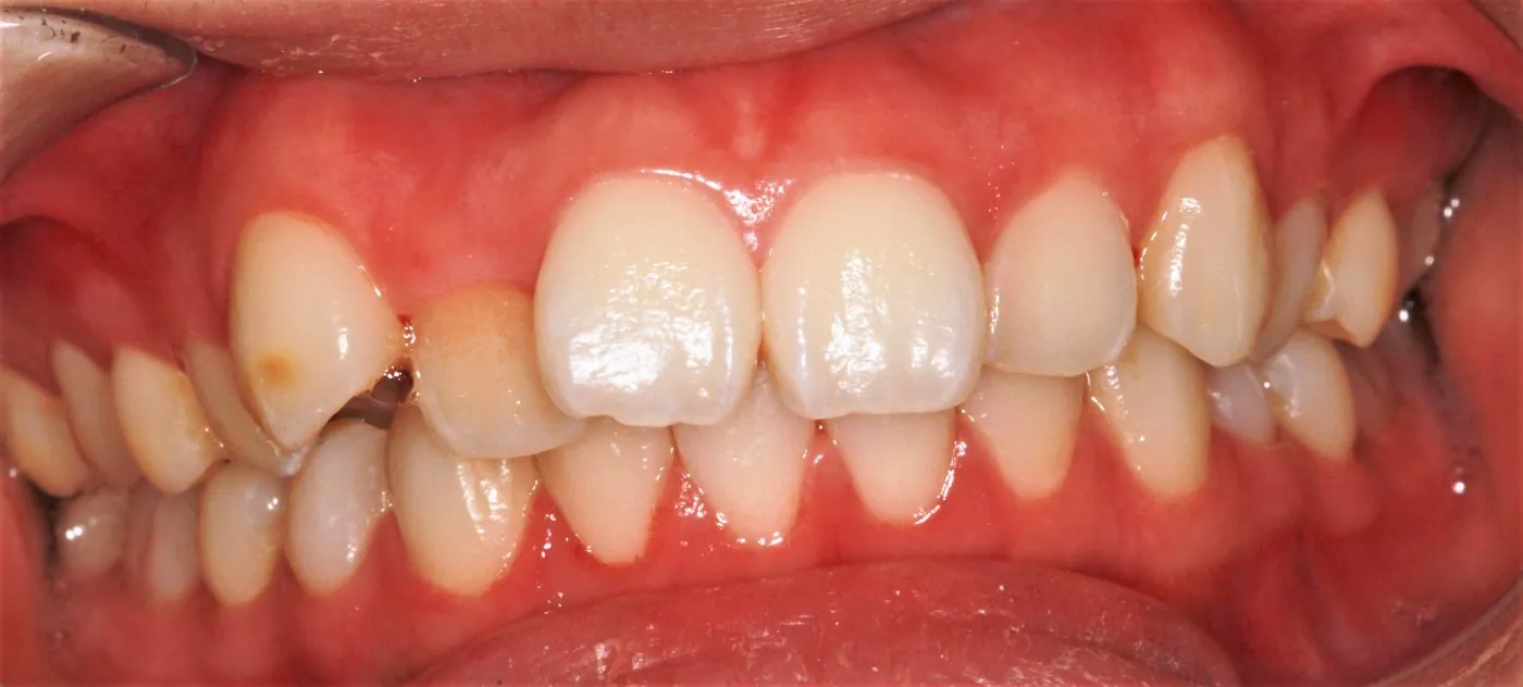 Before treatment
