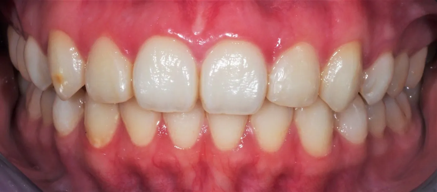 After treatment