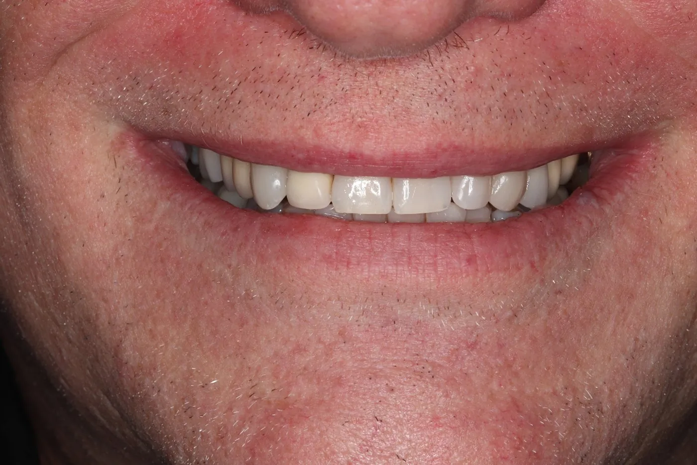 After: Six crowns to replace stained, 15-year-old dental work