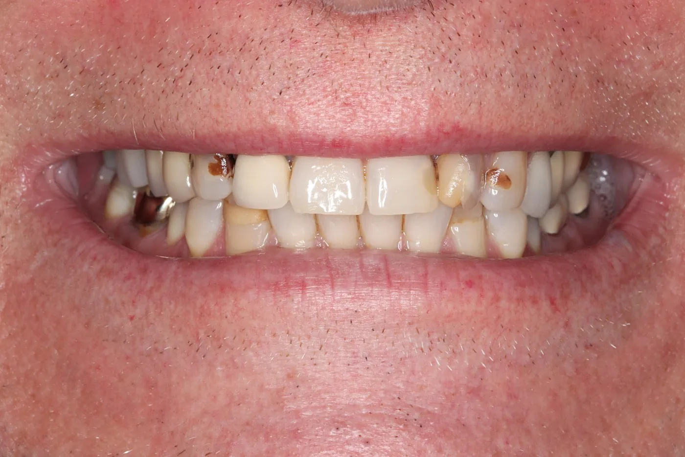 Before: Six crowns to replace stained, 15-year-old dental work