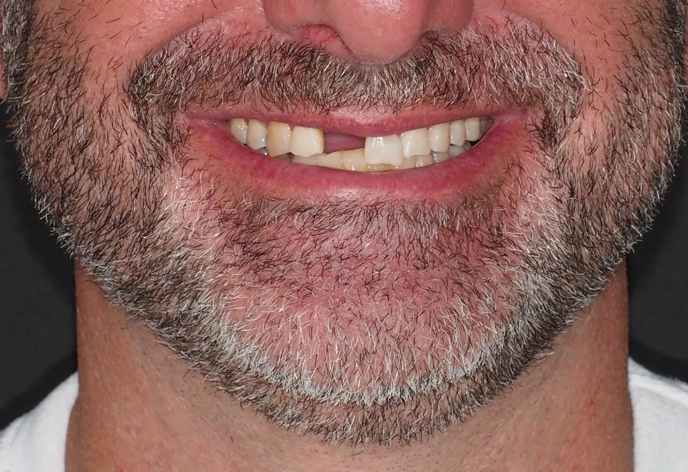 Before treatment