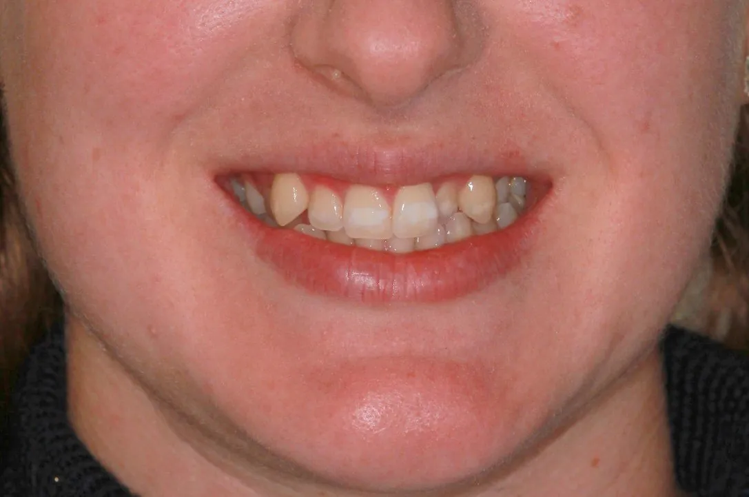 Before treatment