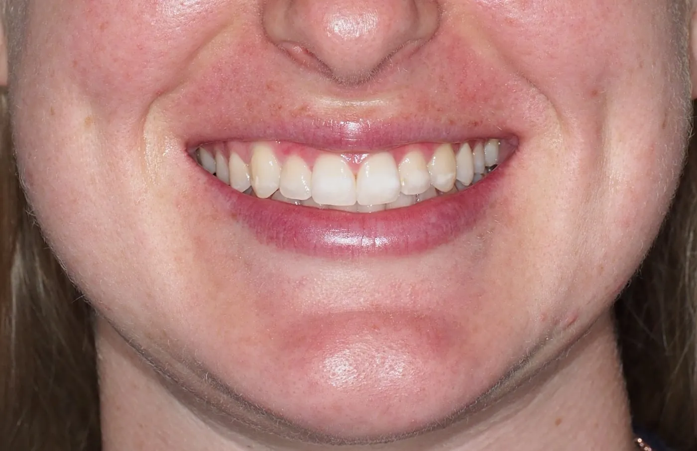 After: A wider, straighter smile in time for a wedding