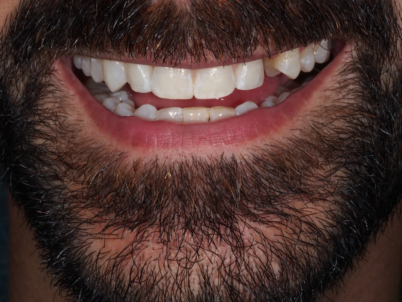 Before treatment