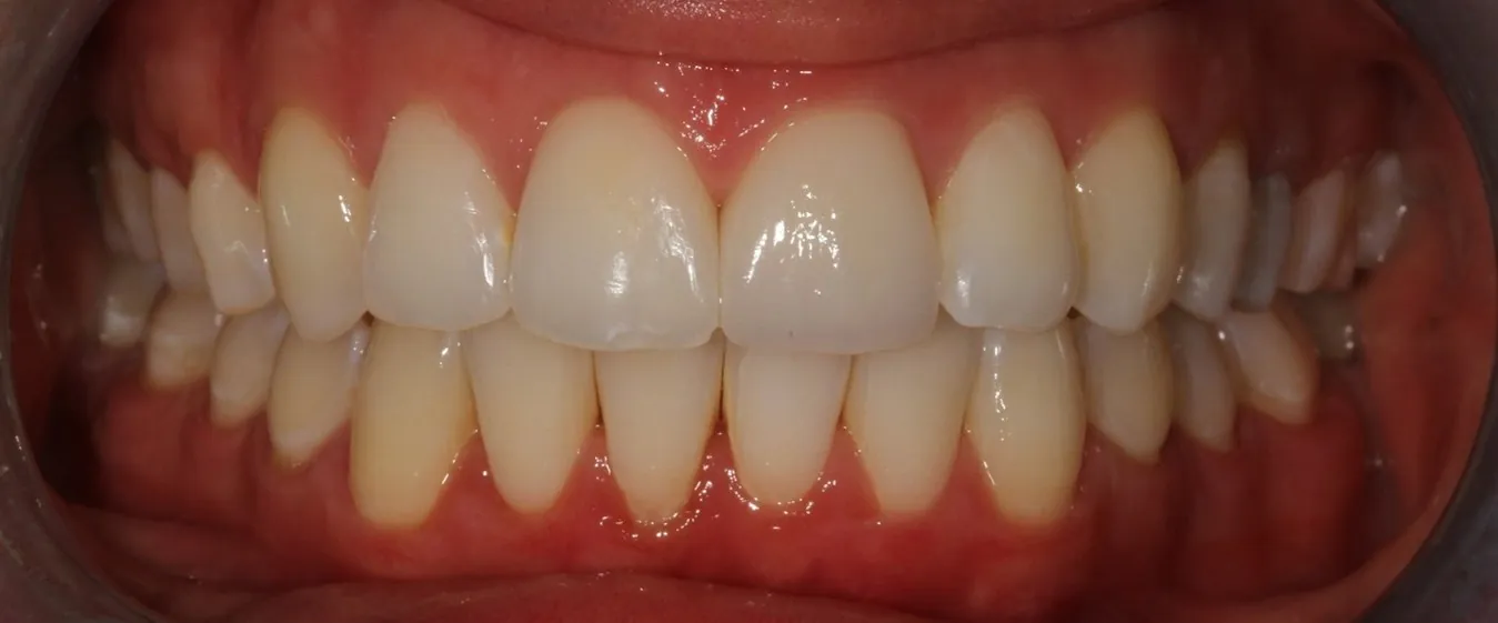 After: A conservative smile makeover: Invisalign, whitening and one crown for a dark front tooth