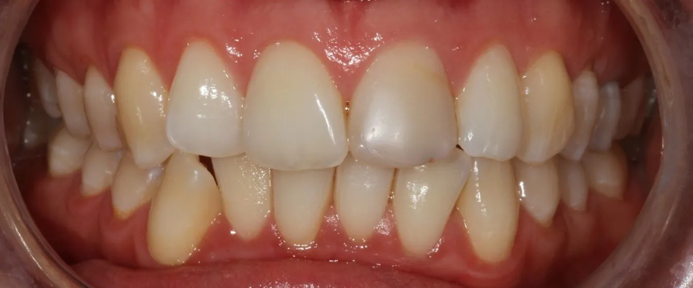 Before: A conservative smile makeover: Invisalign, whitening and one crown for a dark front tooth