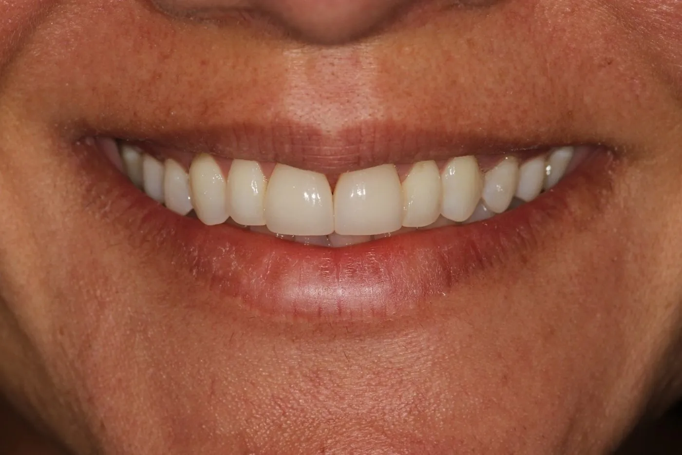 After: Fixing a reverse smile arc with aligners, two crowns and whitening, without veneers